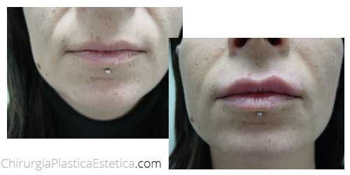 Acido ialuronico labbra prima e dopo