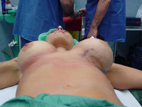 Ematoma mammella sinistra dopo una mastoplastica additiva