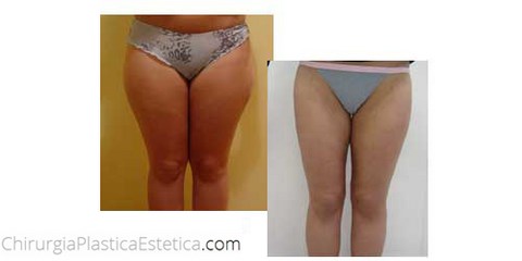 Liposcultura prima e dopo