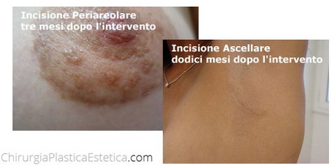 Mastoplastica Additiva Roma: incisioni e cicatrici