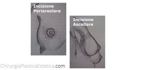 Mastoplastica additiva incisioni ascellare e periareolare