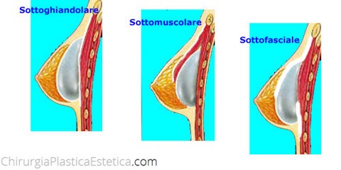 Piani di inserimento delle protesi mammarie
