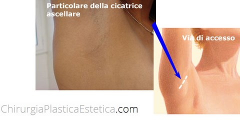 Incisione e cicatrice ascellare