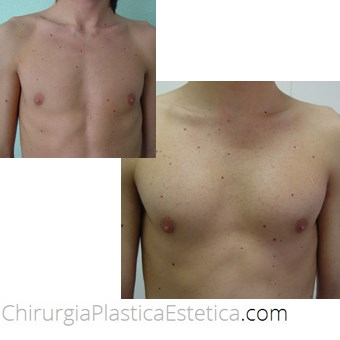 Protesi pettorali maschili prima e dopo