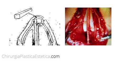 Spreader graft