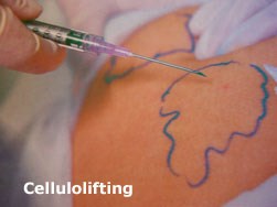 Cellulolifting