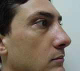 Chirurgia Plastica Estetica del naso dopo