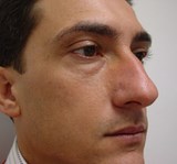 Chirurgia Plastica Estetica del naso prima